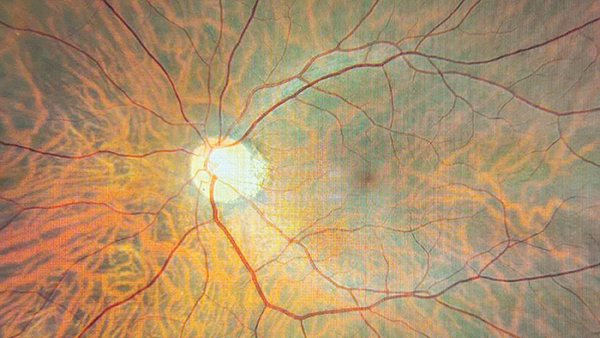 Advancing AI in Eye Care