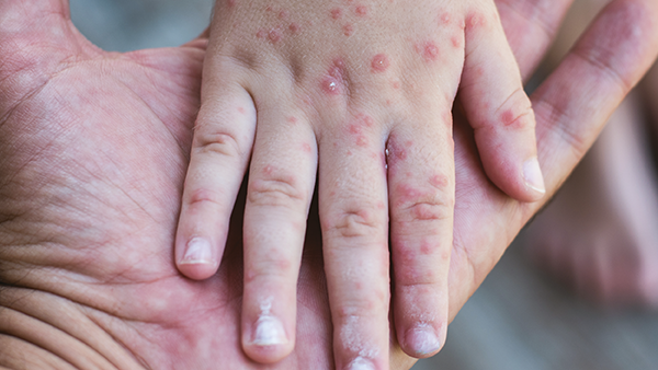 Is Measles Making a Comeback?