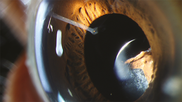 1023-203-Haag Streit-Slit-Lamp-Competition-Thumbnail.png