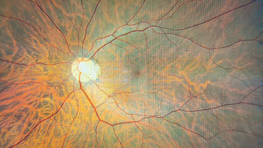 The (Unknown) Power of Retinal Imaging